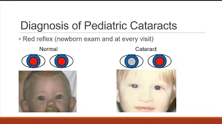Pediatric Cataract
