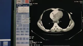 ازاي اشتغل فحوصات الأشعة المقطعية بالصبغة  باستخدام smart prep GE. CT