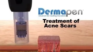 MicroNeedling for Acne Scars - Dermapen® Treatment