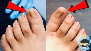 PINCER PERFECT TOENAILS?! ***FIXING CURVED NAIL SHAPE WITHOUT SURGERY***