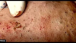 Super Blackheads Part 3 | Ga Spa| 09.02.2022