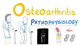 Osteoarthritis (OA) Part 3: Pathophysiology