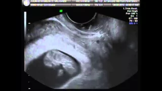 Vídeo para anunciar gravidez - ultrassom  9 semanas. Bebê Samuel.