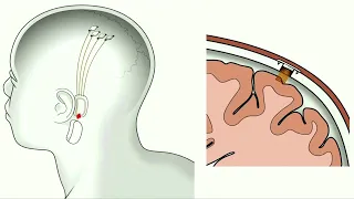 Musk's Neuralink says has FDA approval for study of brain implants in humans