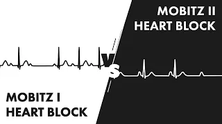 Mobitz Type I vs Type II Second Degree Heart Block