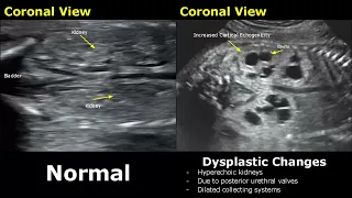 Fetal Kidneys Ultrasound Normal VS Abnormal Image Appearances | Kidney Abnormalities USG | Ob/Gynae