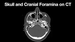 Anatomy of the Skull on CT