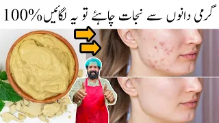 How to Remove Pimples Overnight | Remove Dark Spots and Blackheads | Acne Treatment | BaBa Food RRC