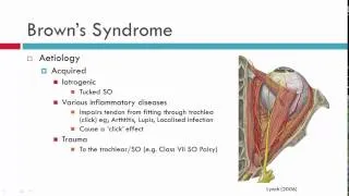 Brown's Syndrome Aeitiology