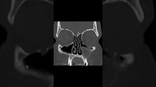 How to Read CT Sinus Maxillary sinus cyst -RadioVideo