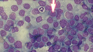 5 Minute Rounds: Lymphoma