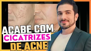 O MELHOR tratamento para CICATRIZES de ACNE - Como melhorar cicatrizes de acne? - Peeling de fenol