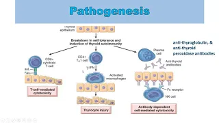 Pathogenesis of Hashimoto thyroiditis