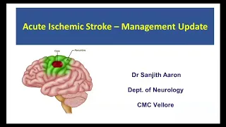 Acute Ischemic Stroke - Management Update