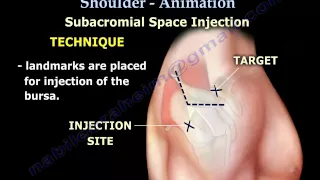 Shoulder bursitis, Tendonitis Injection Animation - Everything You Need To Know - Dr. Nabil Ebraheim