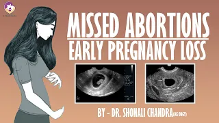 Missed Abortion : Early Pregnancy Loss : Clinical Scenarios : Dr. Shonali Chandra