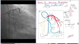 Coronary Angiogram. RAO caudal view.