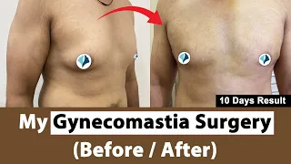 My Gynecomastia Surgery Result After 10 Days