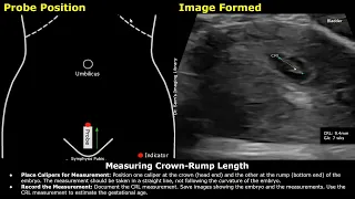 Step By Step Guide On 7 Week Pregnancy Transabdominal Ultrasound Scan | Full Protocol With Reporting