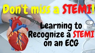 Recognizing a STEMI on an ECG : Emergency Nursing Tips for New Grads