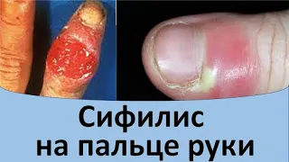 Сифилис на пальцах рук