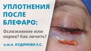 Уплотнения и шишки на веках после блефаропластики – осложнение или норма?