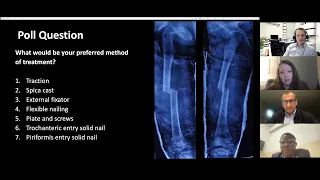 SIGN/IGOT Pediatric Diaphyseal Femur Fractures Webinar (2/1/22)