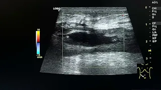 abdominal wall abscess in appendectomy wound