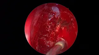 Endoscopic orbital decompression - Dr Babu A R ENT surgeon JSSMC Mysuru