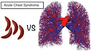 acute chest syndrome in sickle cell patients