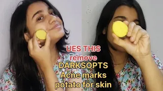 Your face to Remove Dark spots, AcneMarks #youtube #Acne#marks#potato #potato for skin