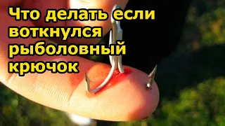 УДАЛЕНИЕ РЫБОЛОВНОГО КРЮЧКА - Порядок действий | Как вытащить рыболовный крючок | Рыбалка в Мумре