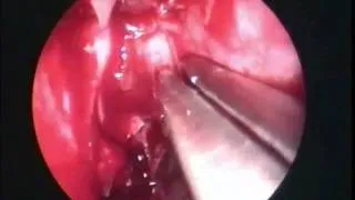 Endoscopic Orbital Decompression