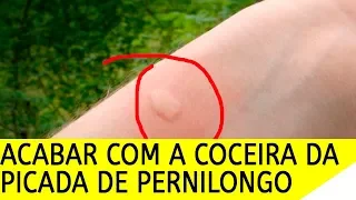 COMO ACABAR COM A COCEIRA DA PICADA DE PERNILONGO E INSETOS