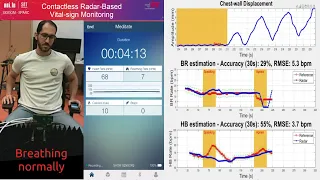 Contactless vital signs estimation using a FMCW radar device