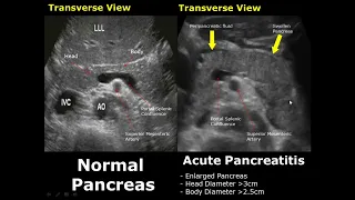 Pancreas Ultrasound Normal Vs Abnormal Image Appearances Comparison | Pancreatic Pathologies USG