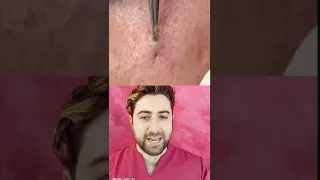 GENTLE and SMOOTH extraction from dilated pore
