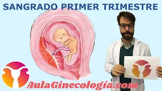 SANGRADO PRIMER TRIMESTRE: Diagnóstico diferencial, causas, ecografía   - Ginecología y Obstetricia