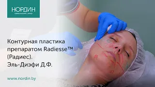 Контурная пластика препаратом Radiesse™ (Радиес)