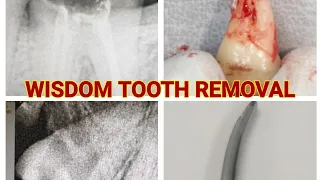 HOW TO REMOVE WISDOM TOOTH AND RCT TREATED TOOTH USING COUPLAND ELEVATOR