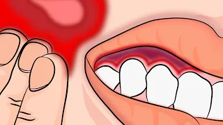 How to Stop your Toothache Pain INSTANTLY and Naturally!