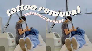GETTING LASER TATTOO REMOVAL AT 18 *vlog* (my experience + why I'm doing it)