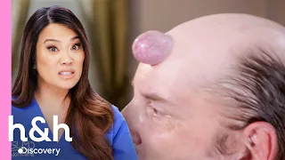 Hombre vive con bulto en cabeza hace 25 años | Dra. Sandra Lee: Especialista en piel | Discovery H&H