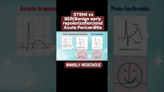 EKG criteria for STEMI vs BER(Benign early repolarization)& Acute Pericarditis @Whollymedicoholic