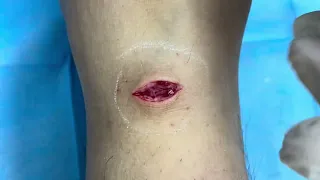 腱鞘囊腫/血管肌瘤切除 美麗新城診所莊禮謙醫師 Ganglion Cyst/ Angioleiomyoma Removal, Dr Geroge