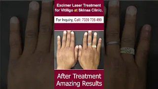 Excimer laser Treatment for Vitiligo at Skinaa clinic #shorts