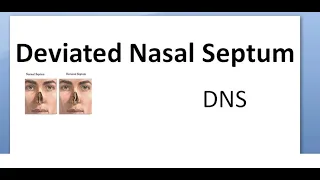 ENT Deviated Nasal Septum DNS Why do I have deviation of nose Causes Types treatment