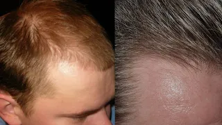 How Often To Apply Minoxidil For Best Hair Regrowth Results