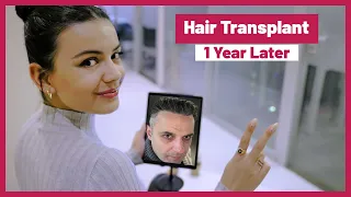 Hair Transplant / 1 Year Later