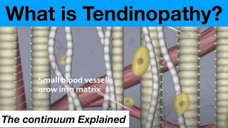 The Tendinopathy Tendon Tendonitis Continuum Theory Explained